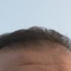 現役医師が語る男性の薄毛のお悩み 解消するには【後編】