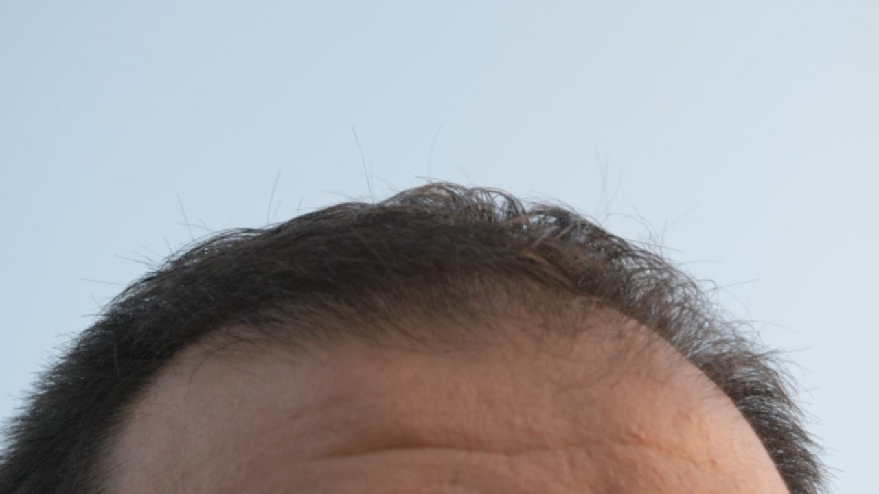 現役医師が語る男性の薄毛のお悩み 解消するには【後編】